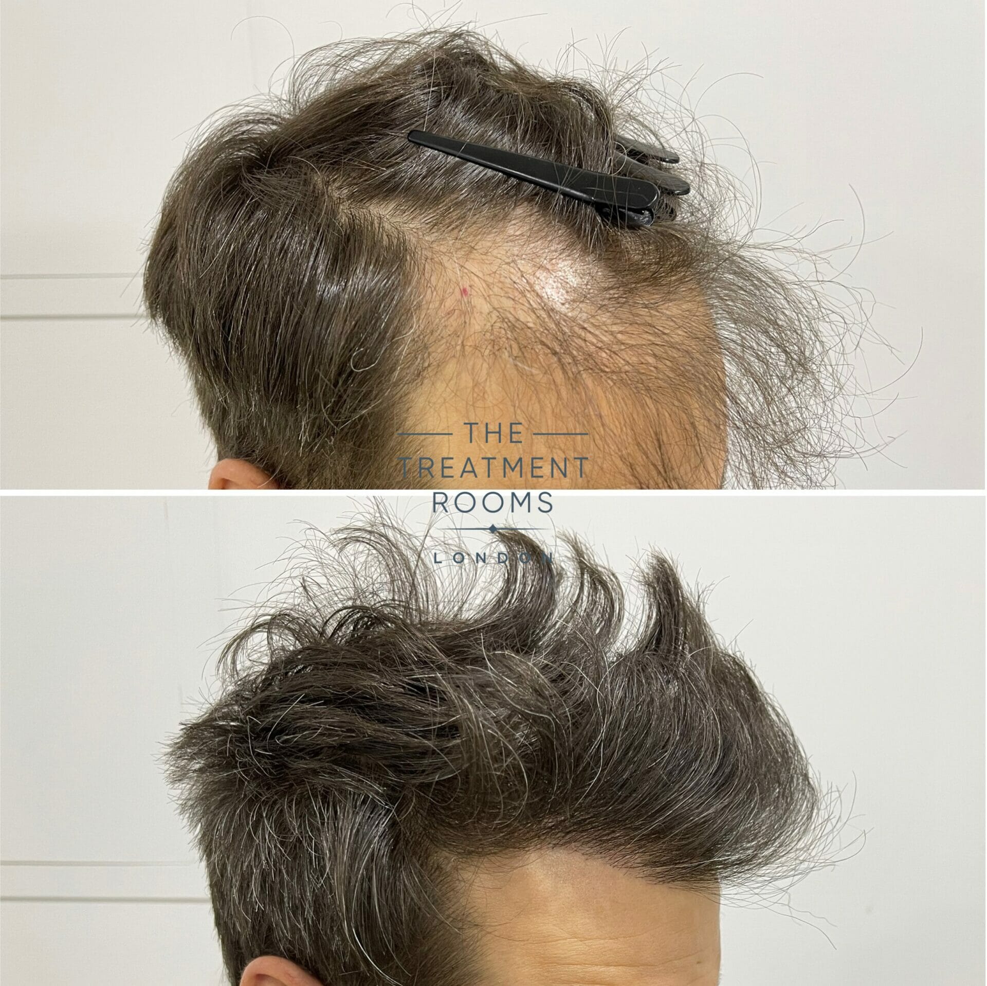 Repair FUE hair transplant before and after