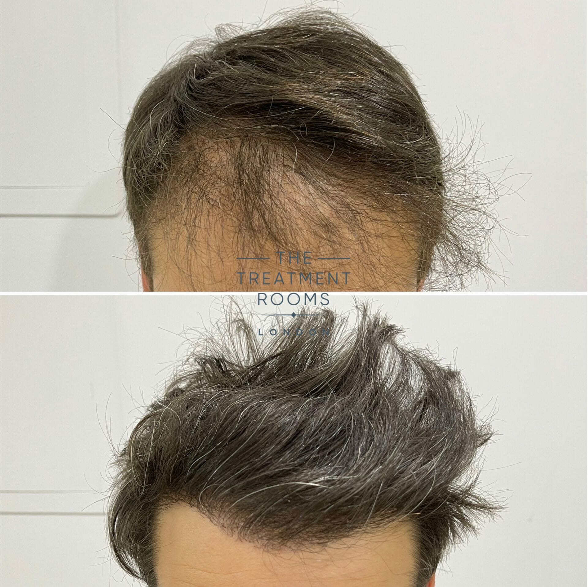 Repair Hair Transplant