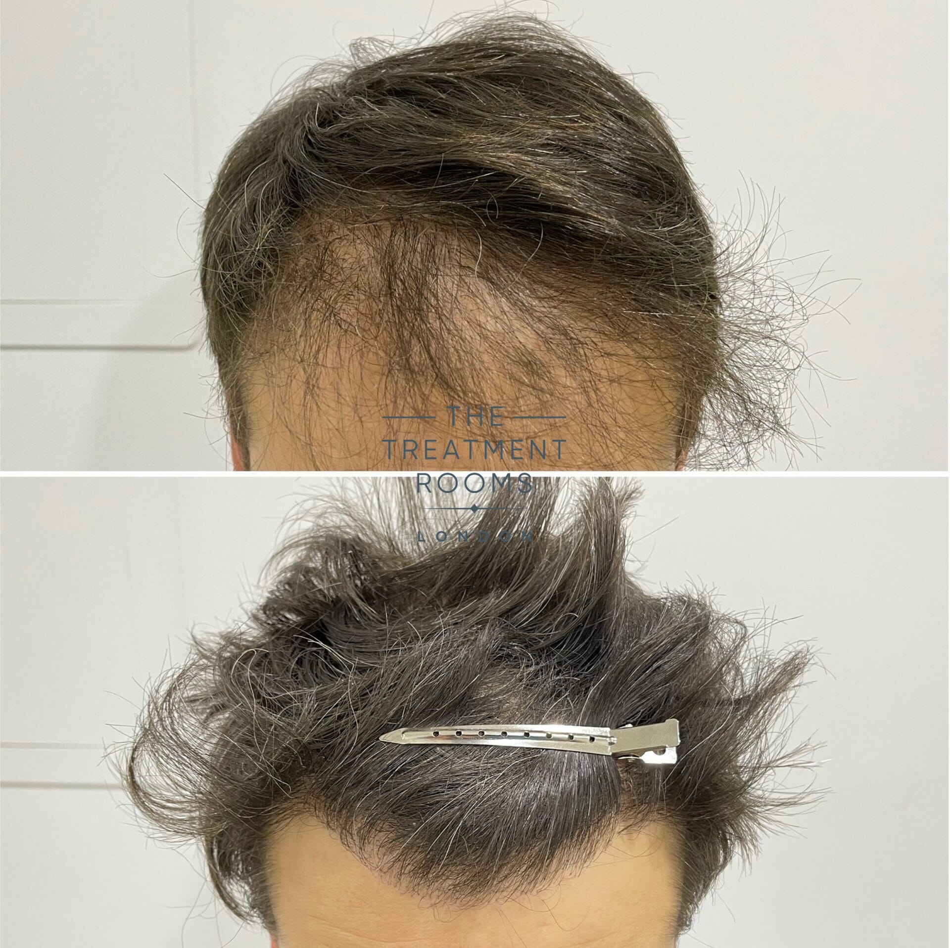 Repair Hair Transplant Hairline before and after