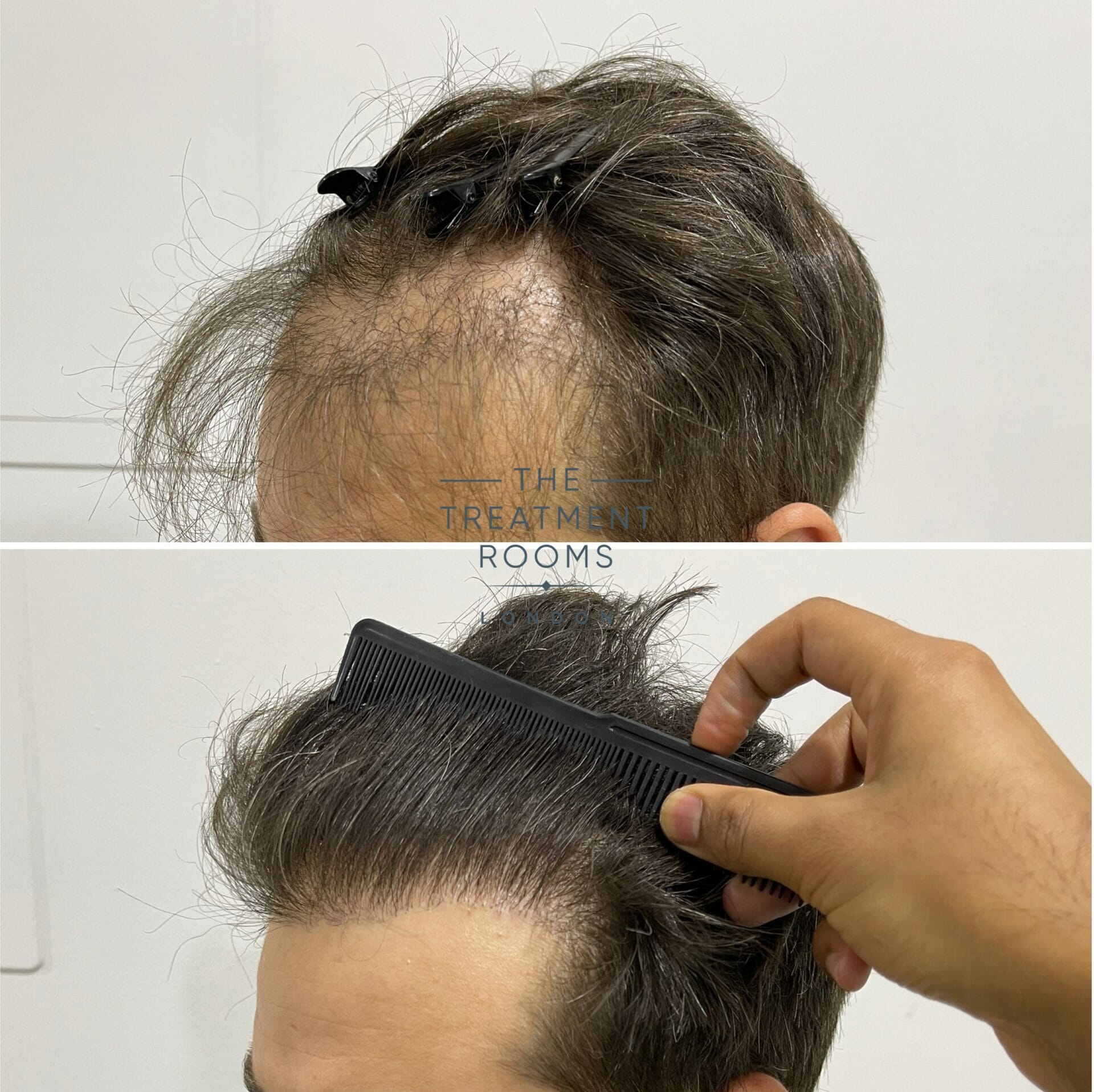 Repair Hair Transplant Hairline before and after