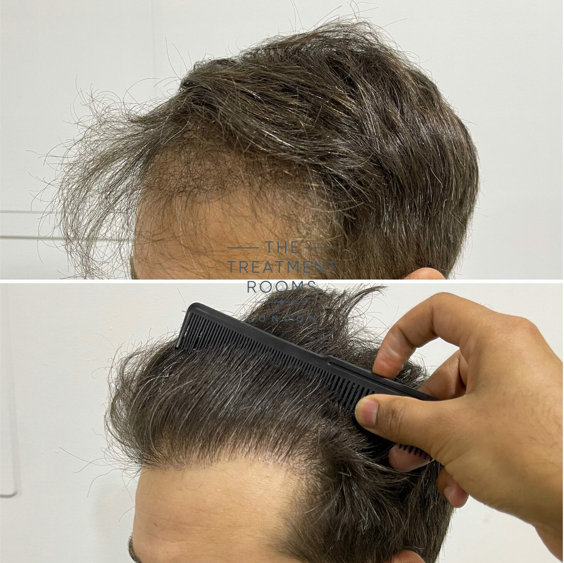 Repair Hair Transplant Hairline result