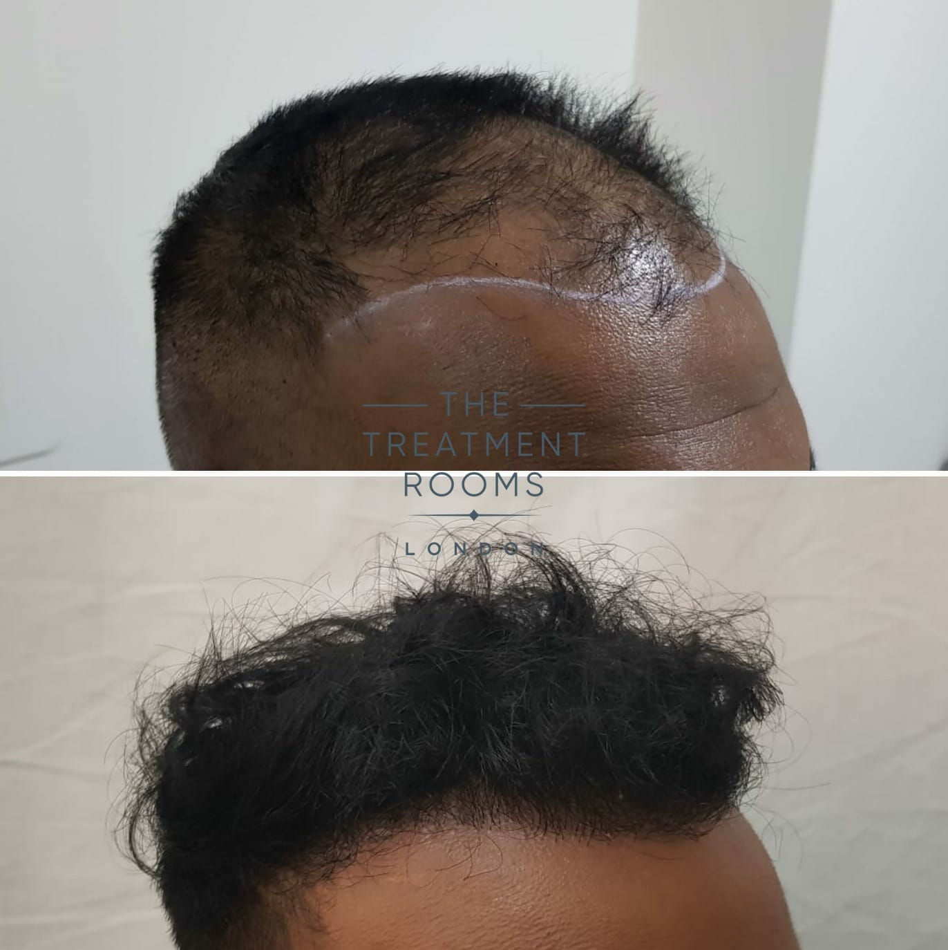 FUE hair transplant before and after 1800 grafts