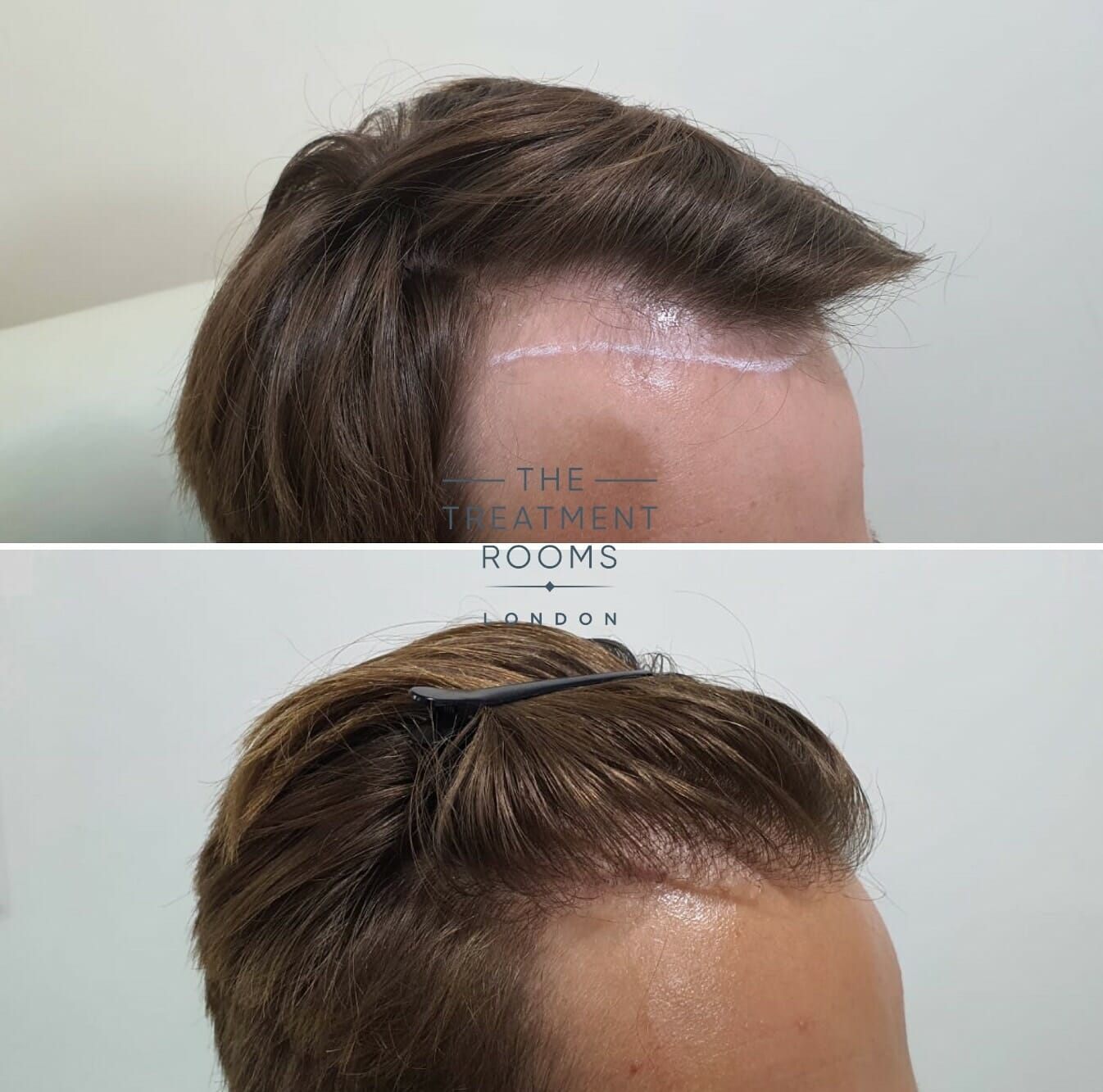 Right Hairline Before and after