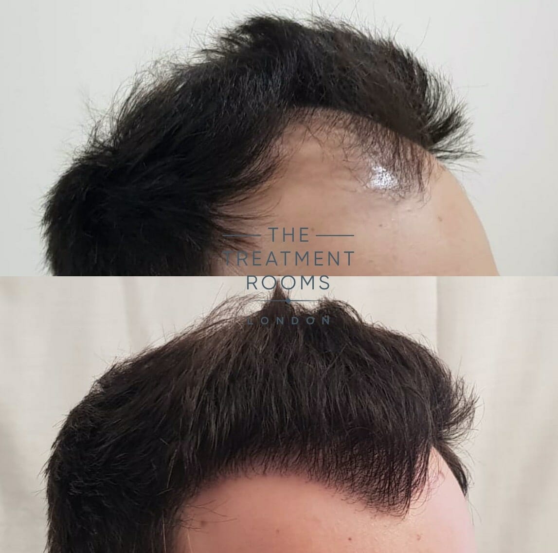 Right Hairline FUE Hair Transplant Right Hairline FUE Hair Transplant