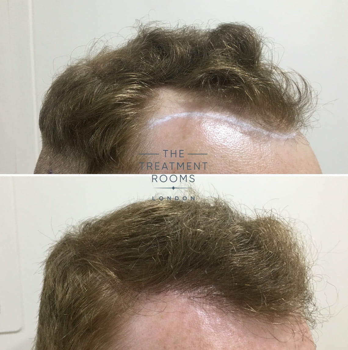 right temple with hairline hair transplant