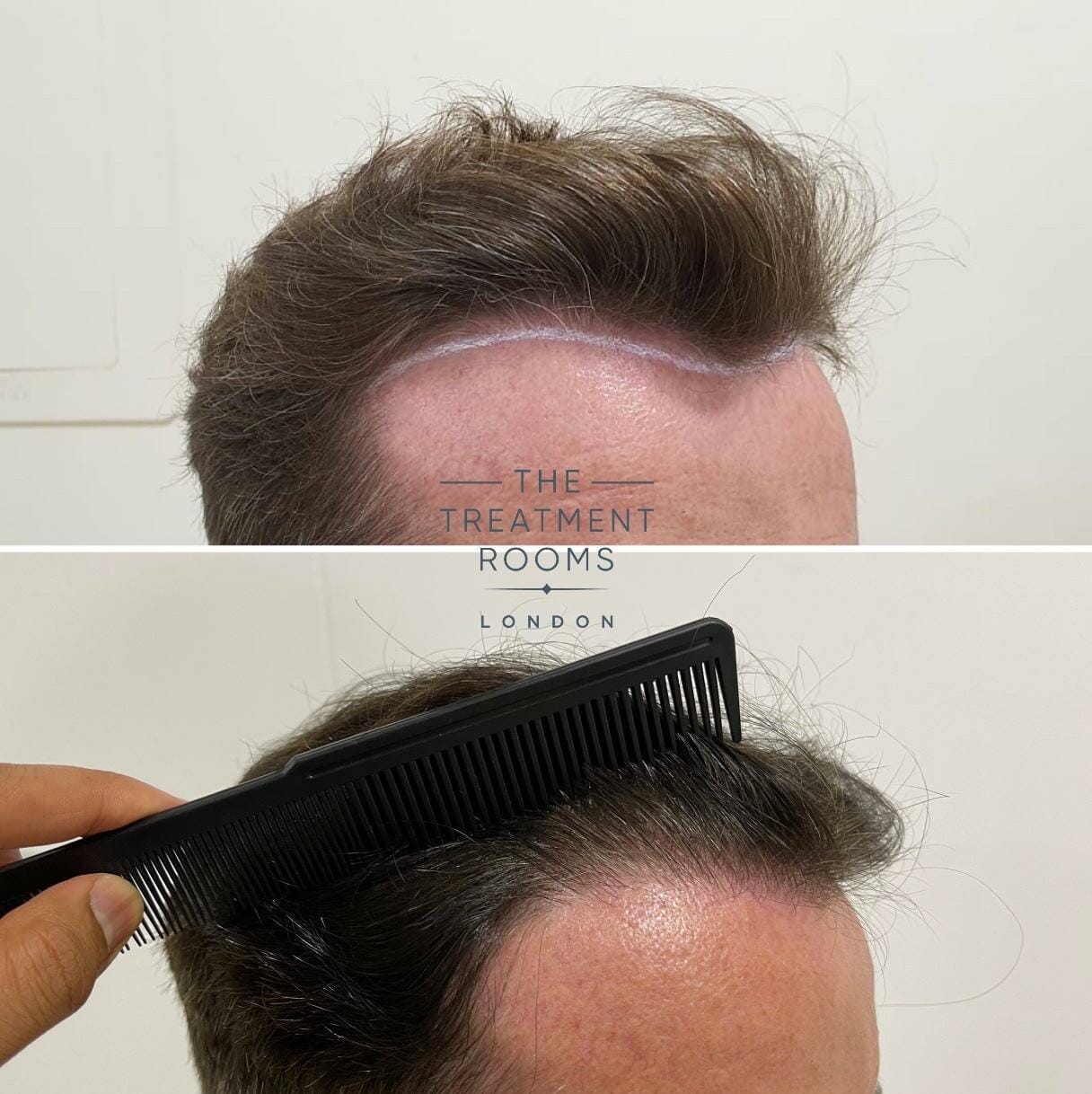 Right frontal hairline hair transplant before and after