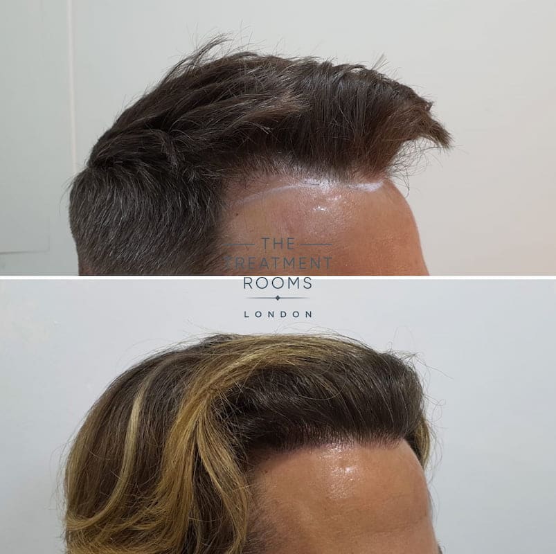 Right hairline DHI hair transplant before and after