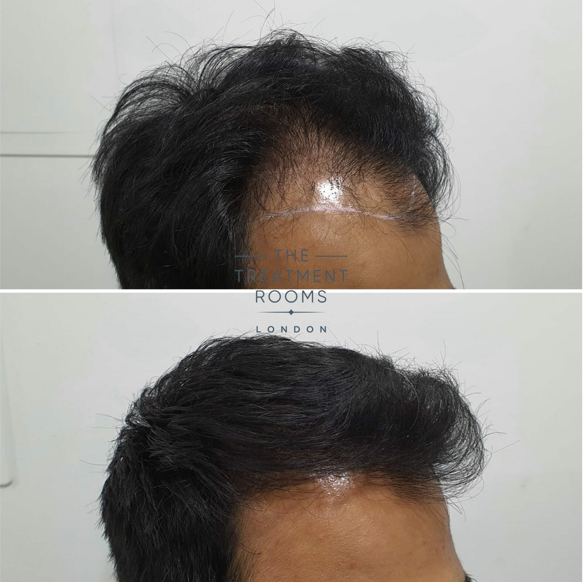 Right hairline FUE hair transplant 1818 grafts