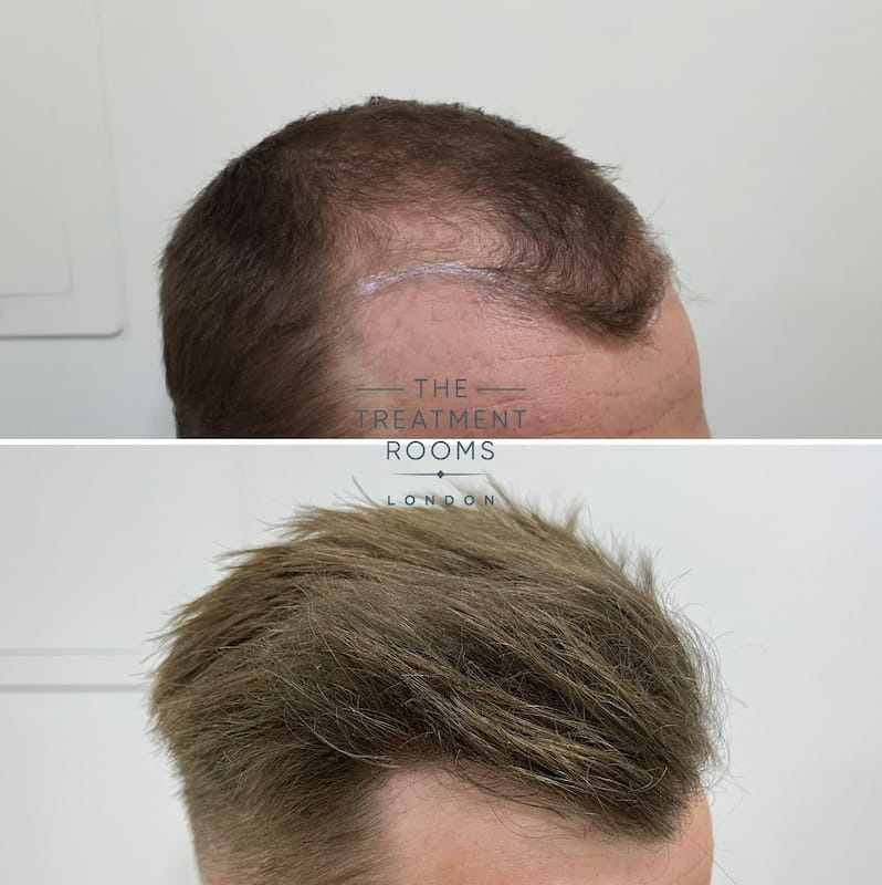 FUE Transplant Before  After  Treatment Rooms London