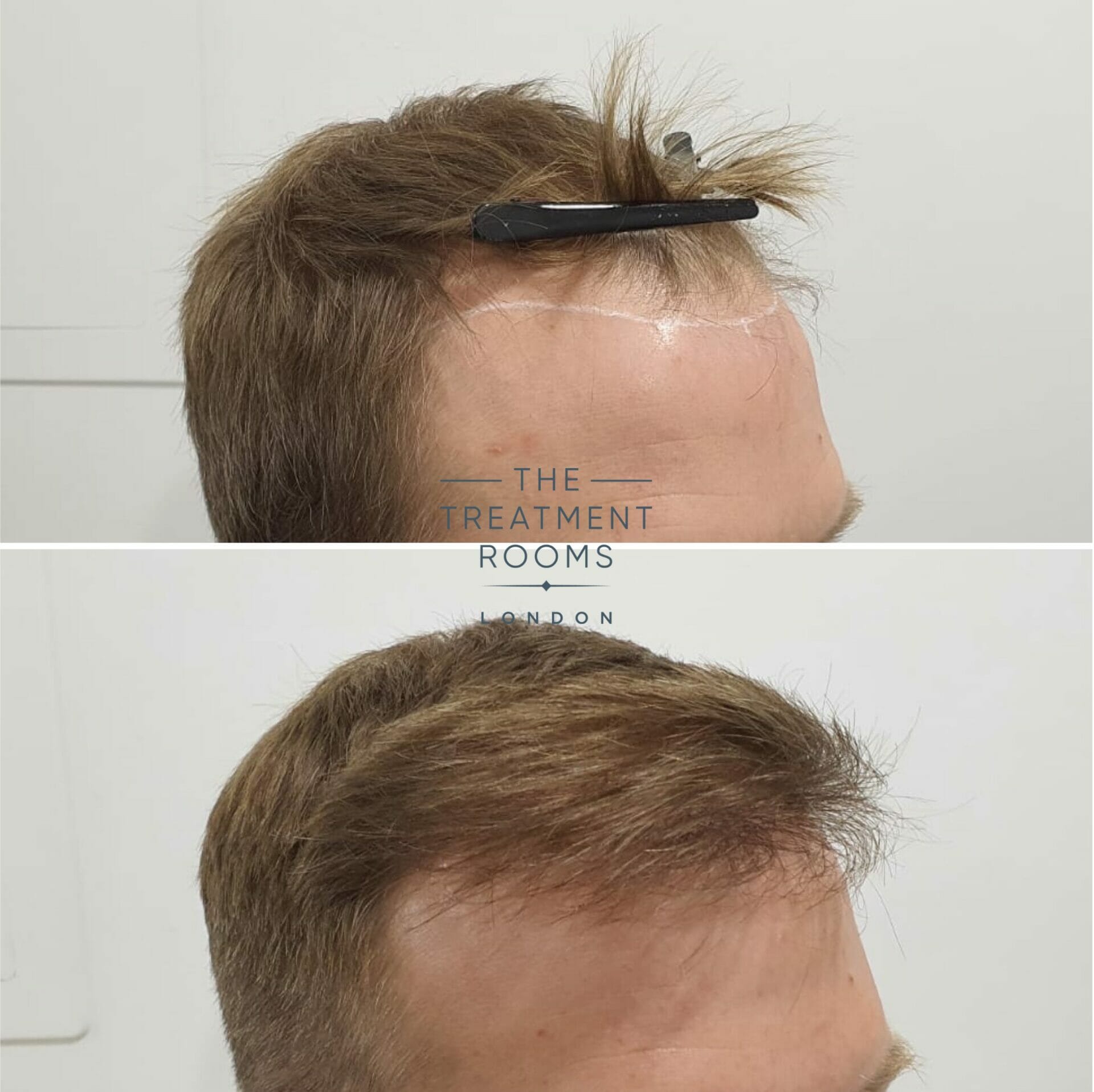 Right hairline before and after hair transplant