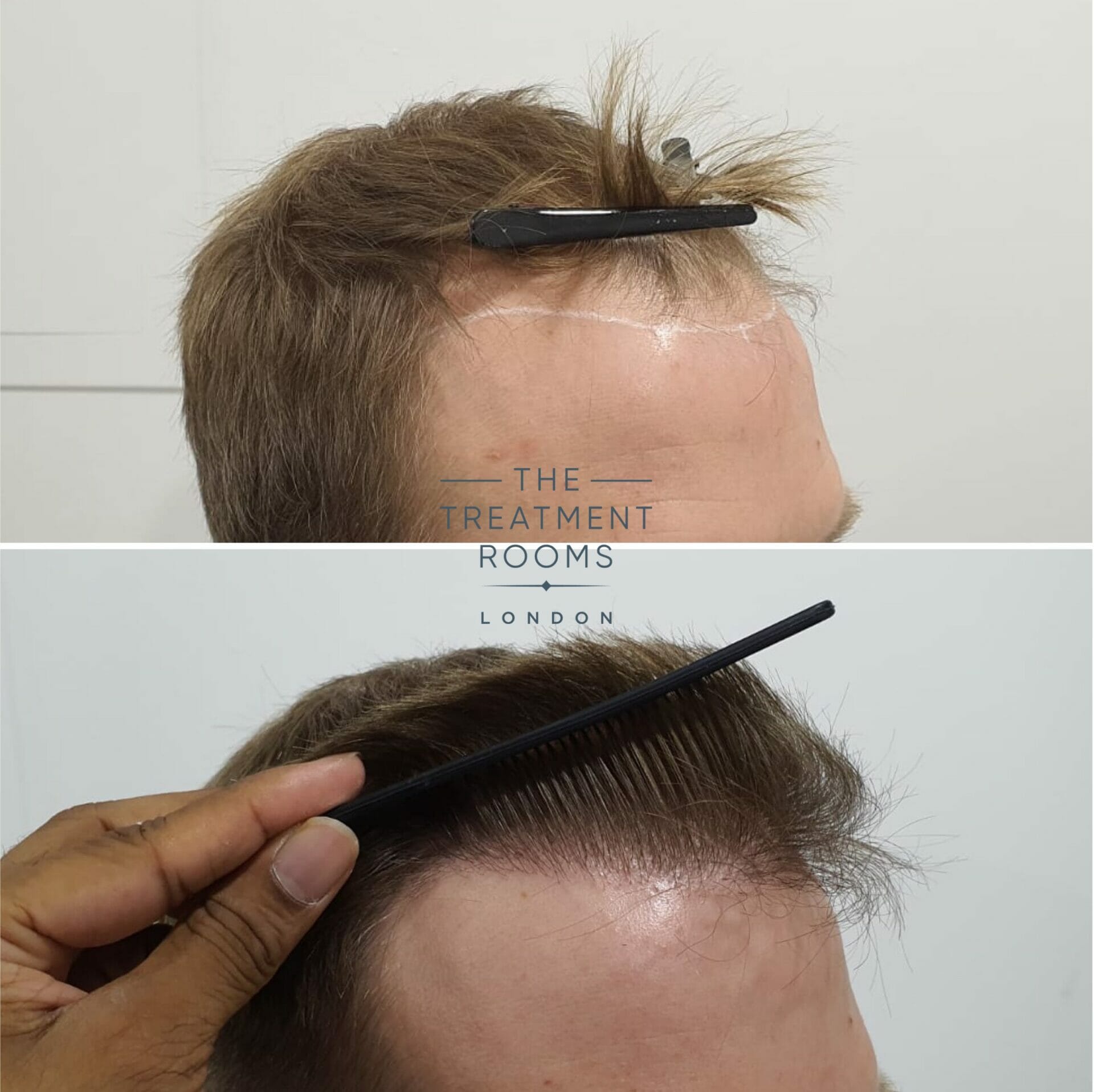 Right hairline before and after FUE hair transplant