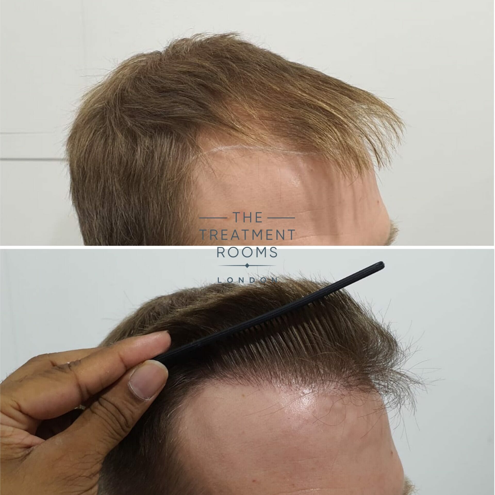 Right hairline before and after hair transplant