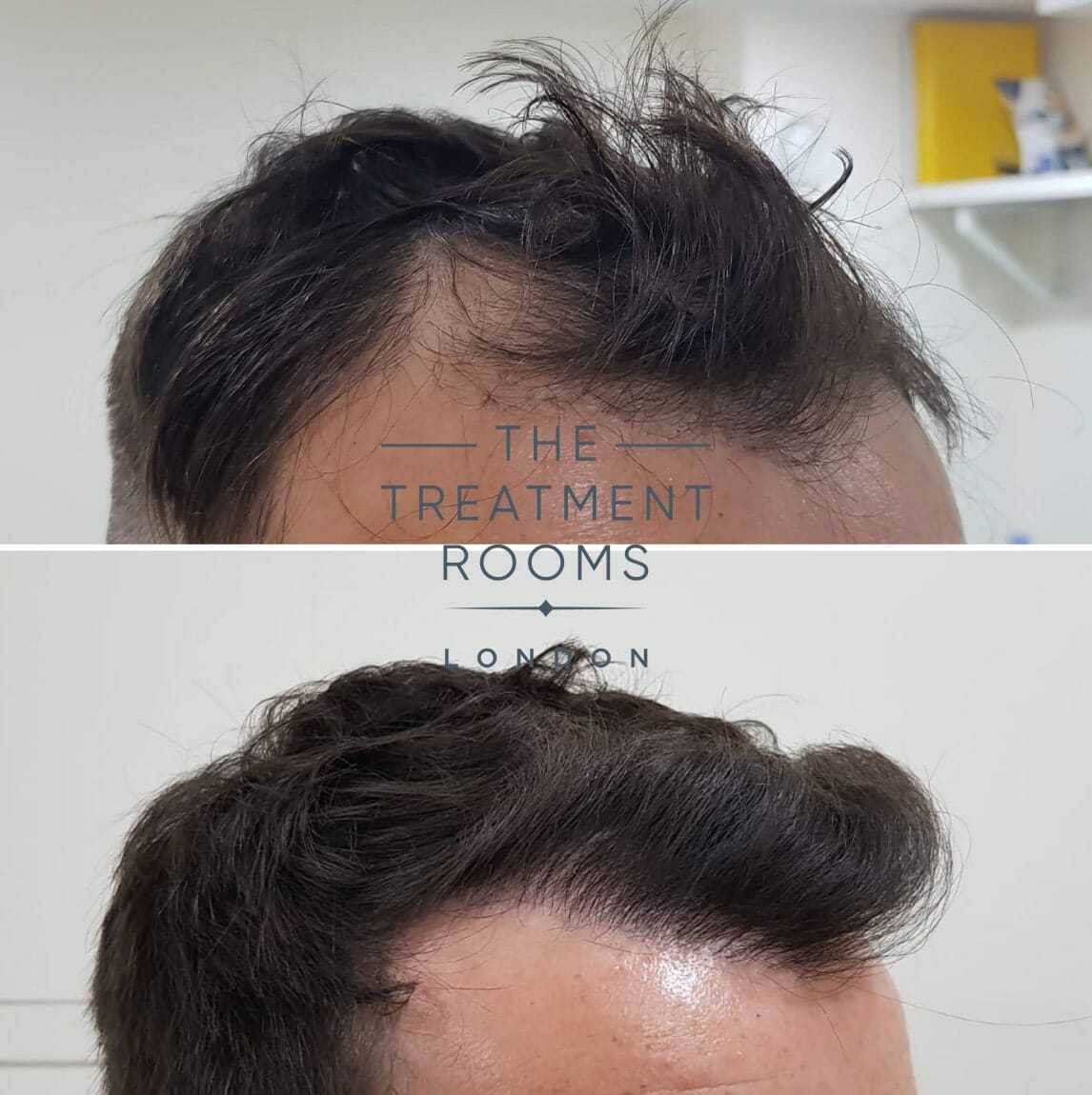 right hairline hair transplant london