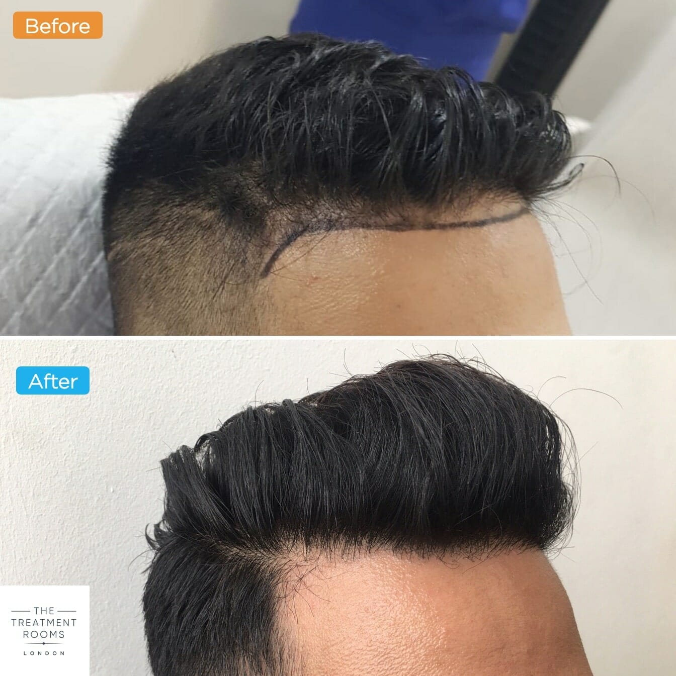 FUE hair transplant right temporal hairline