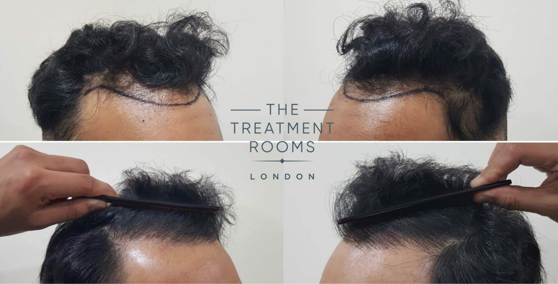 Hair transplant result left and right temporal hairline fue hair transplant before and after hairline