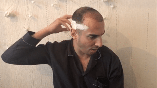 FUE Hair Transplant Side Effects & How To Treat Them | Treatment Rooms  London