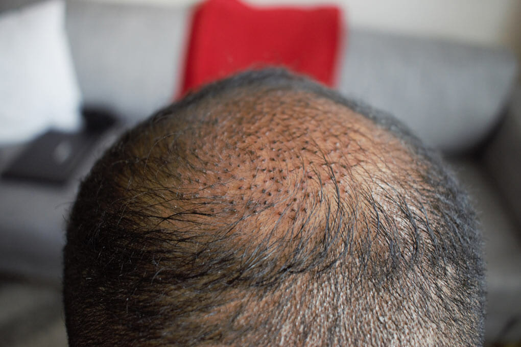 Crown Hair Transplant Hair Transplant Specialists Treatment