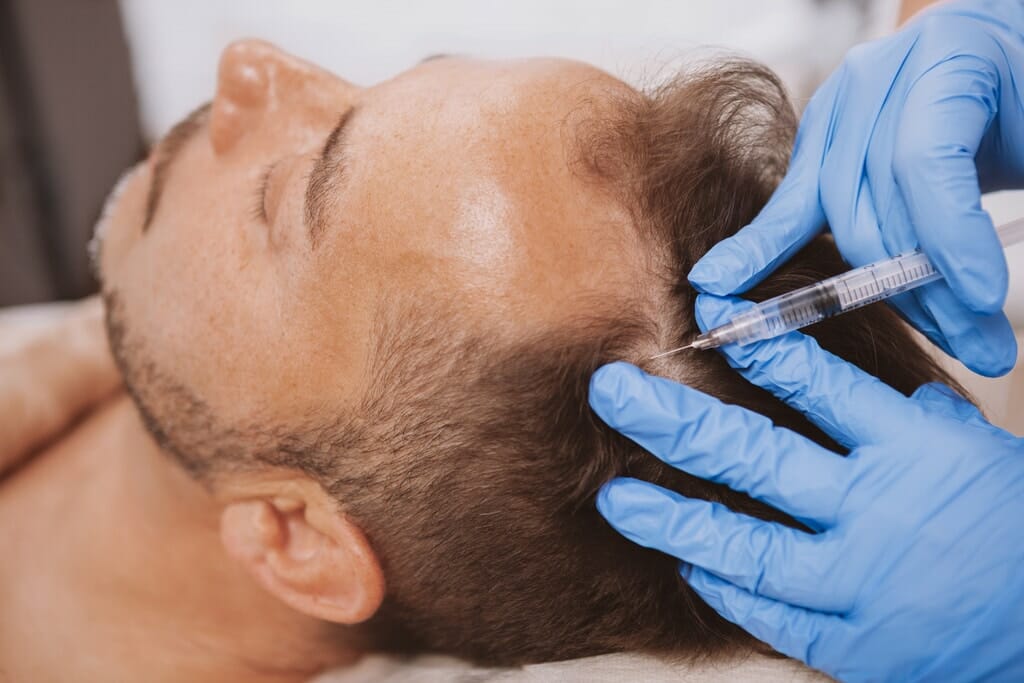 PRP injections hair loss