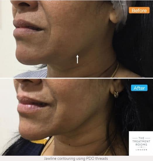 Jowl Thread Lift