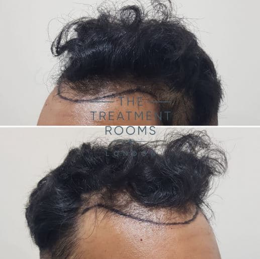 Frontal FUE hair transplant London