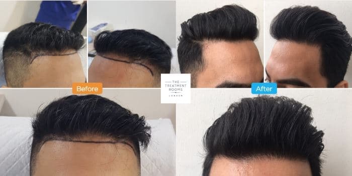 Hair Transplant before and after results