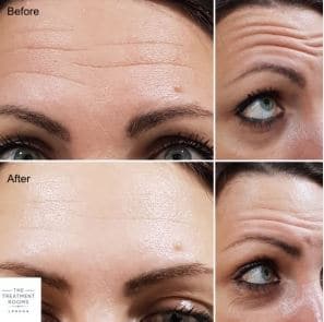 TRd Botox forehead before and after