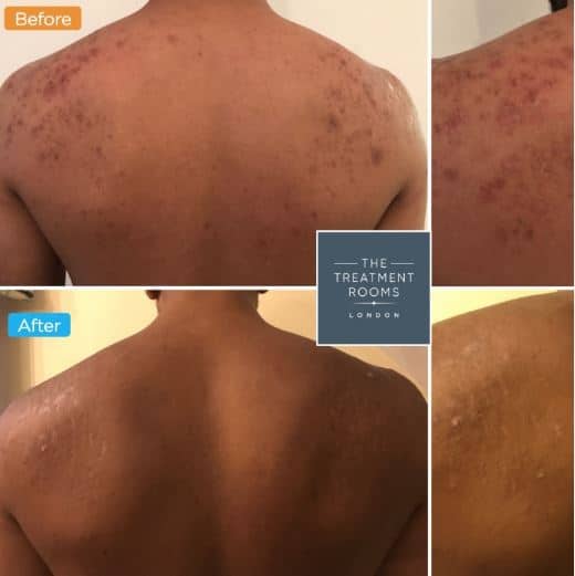 PRP Microneedling (Vampire facial)