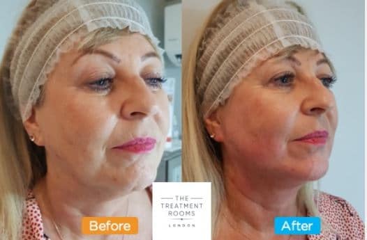 Face thread lift London Face thread lift london