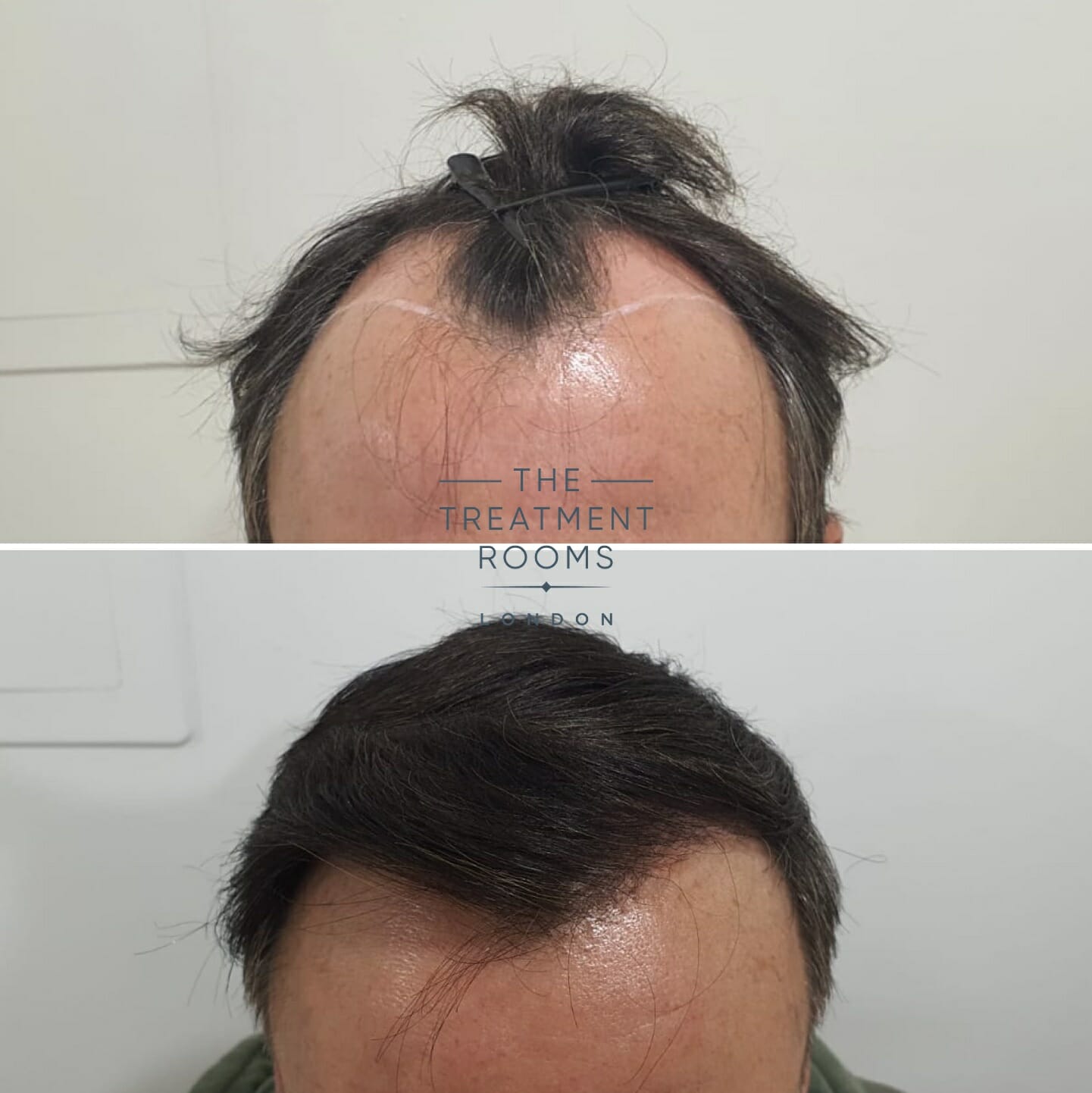 Temple FUE hair transplant London