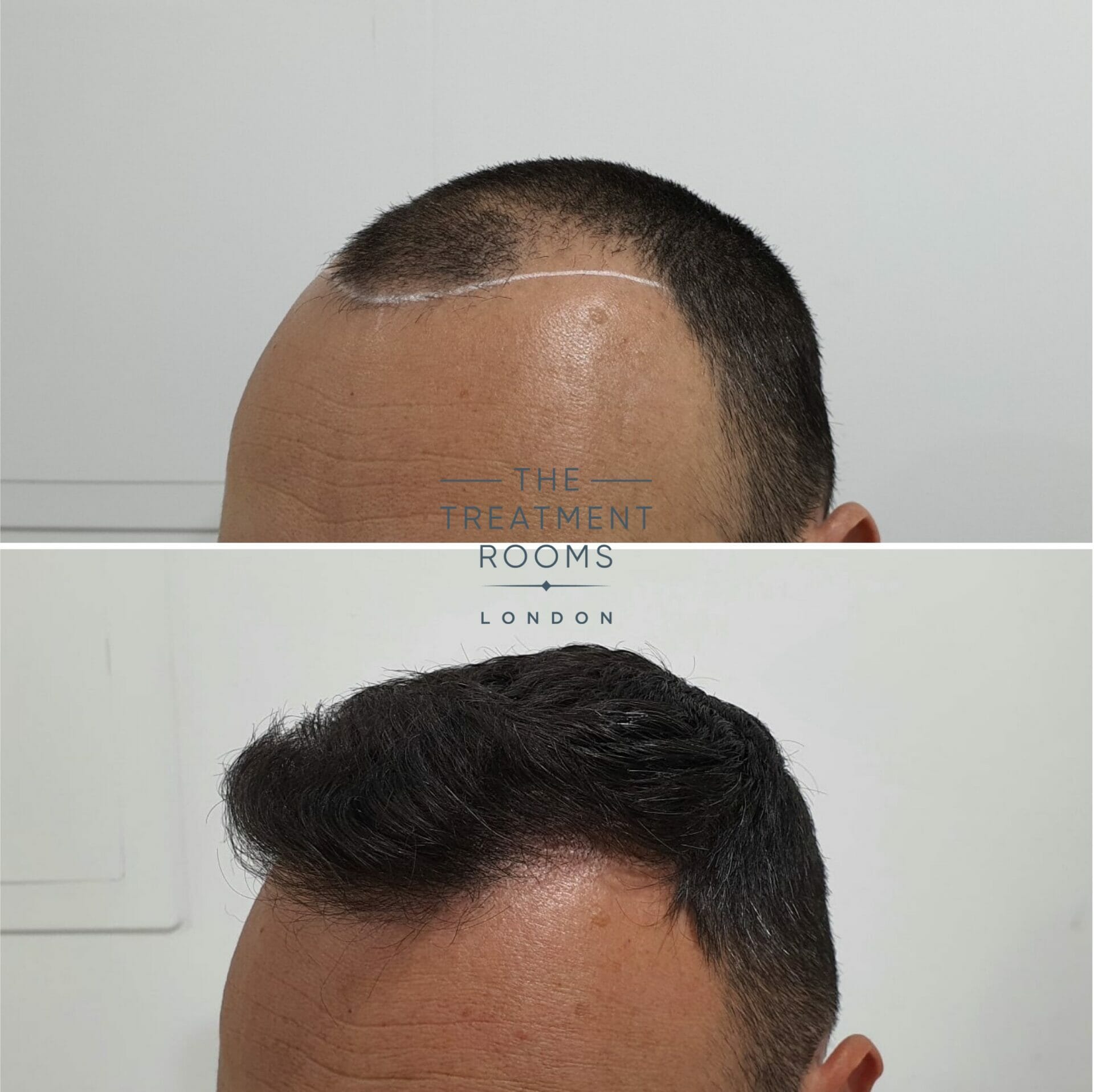 Temple FUE hair transplant before and after 1498 grafts