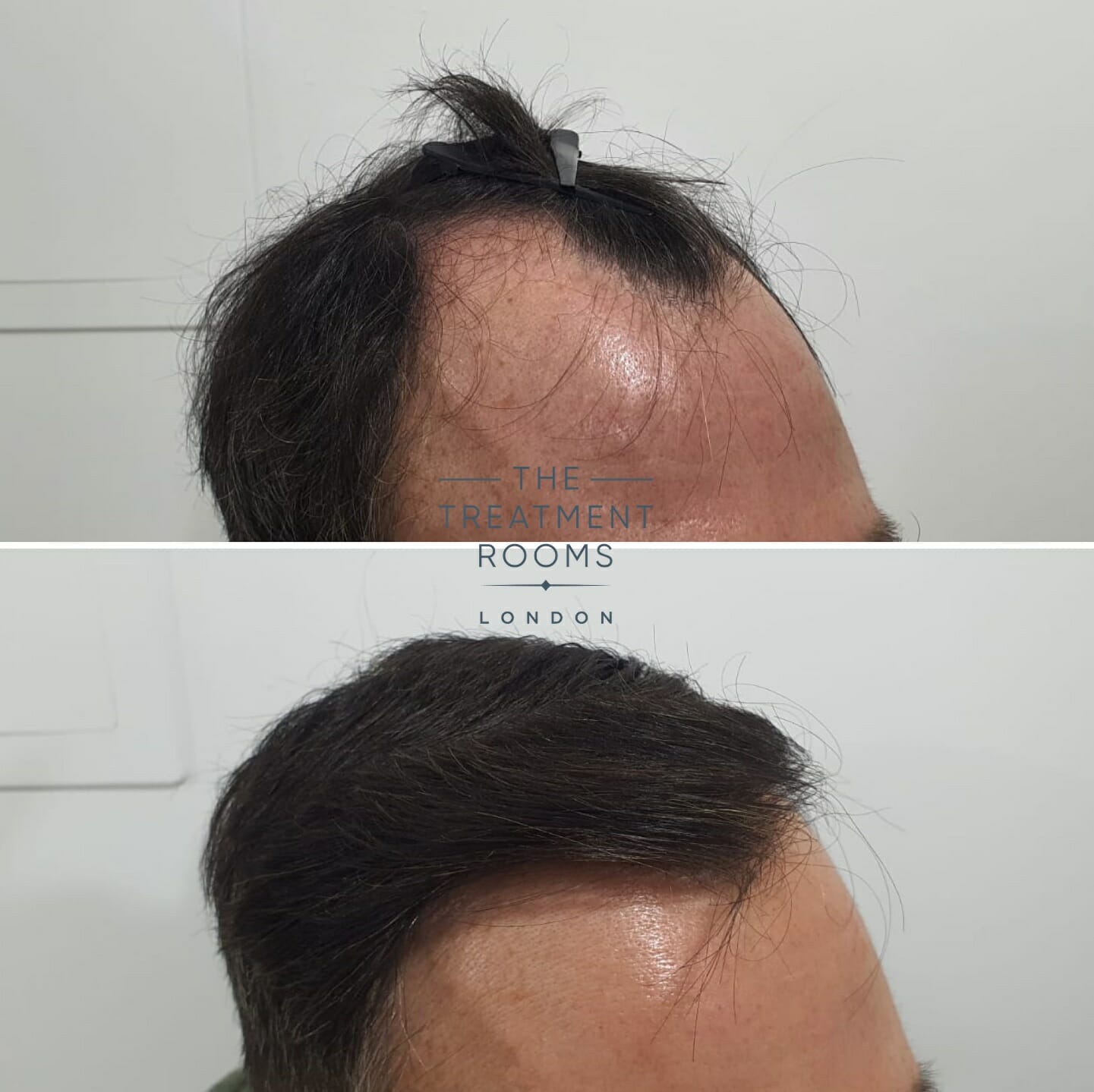 Temple FUE hair transplant result 1800 grafts