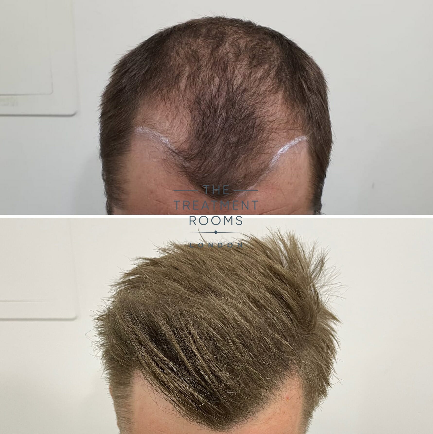 Temple hair loss treatment