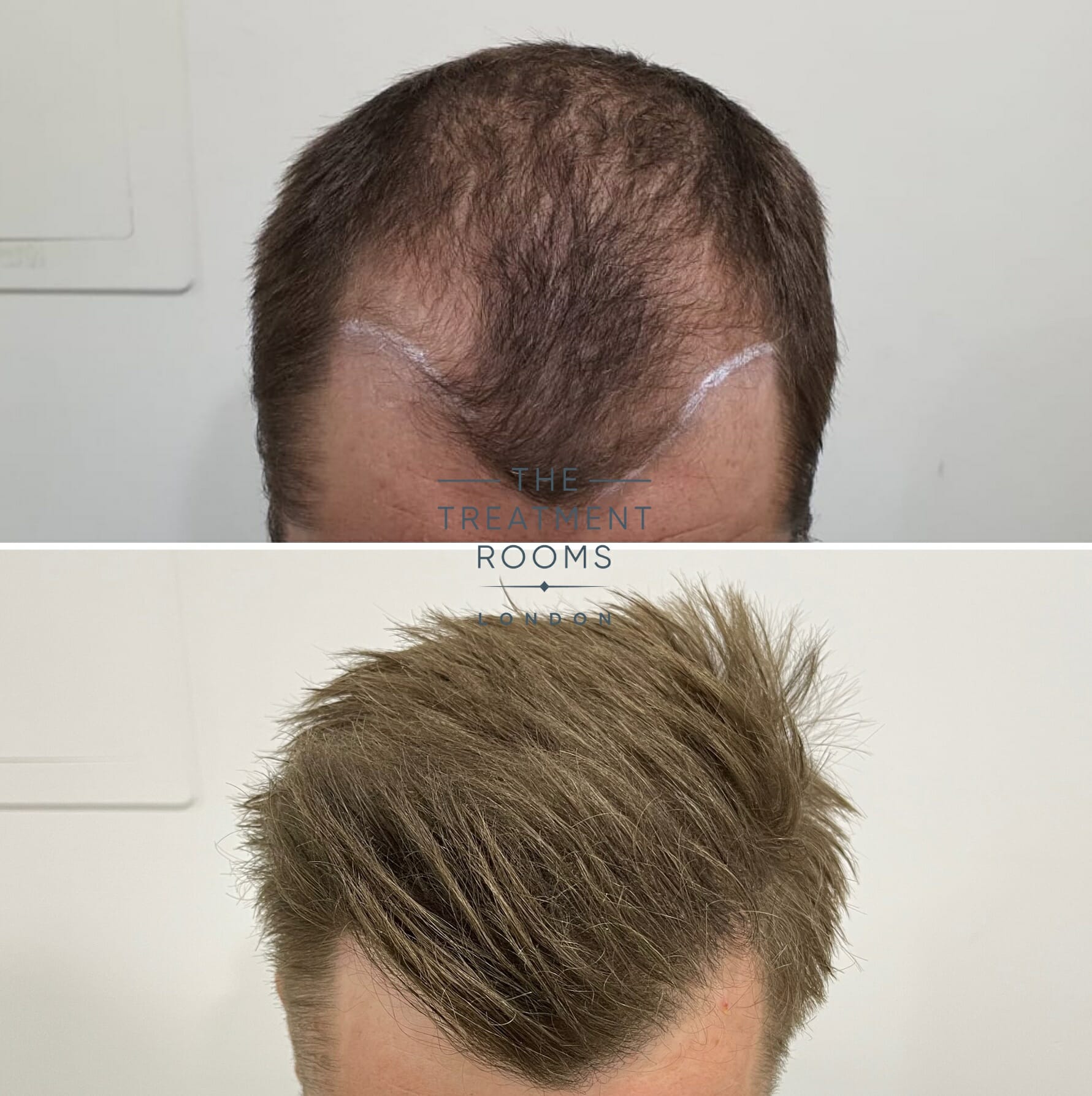 Temple discount hair loss