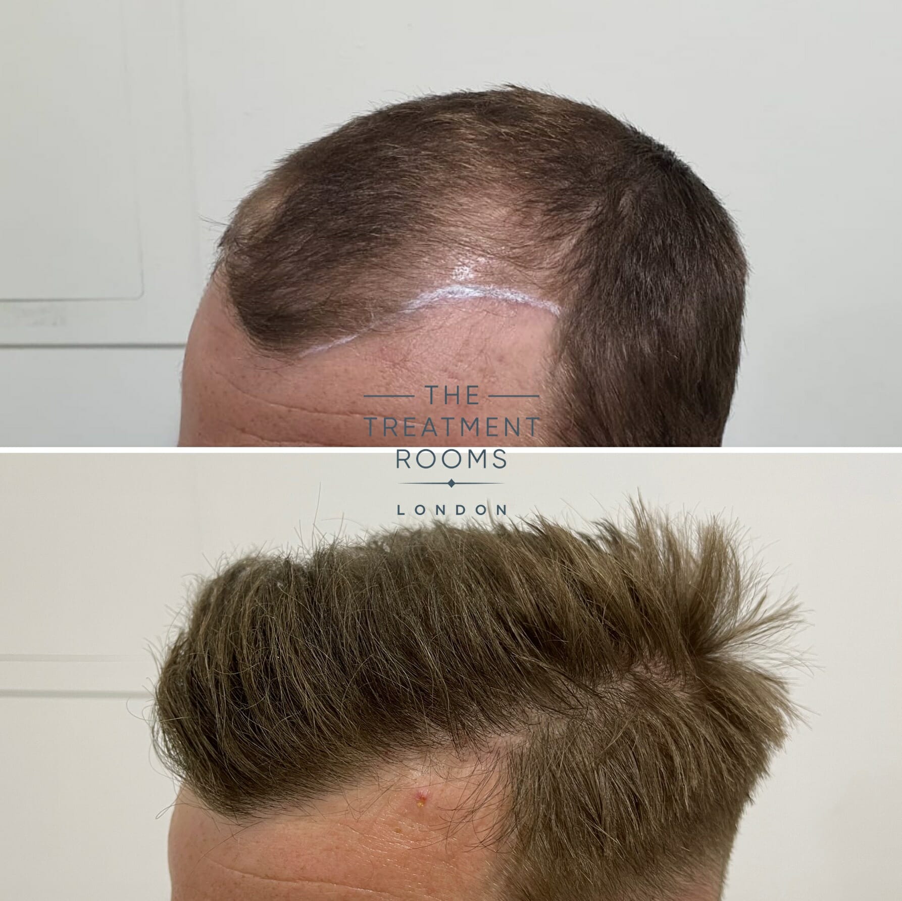 Temple hair loss