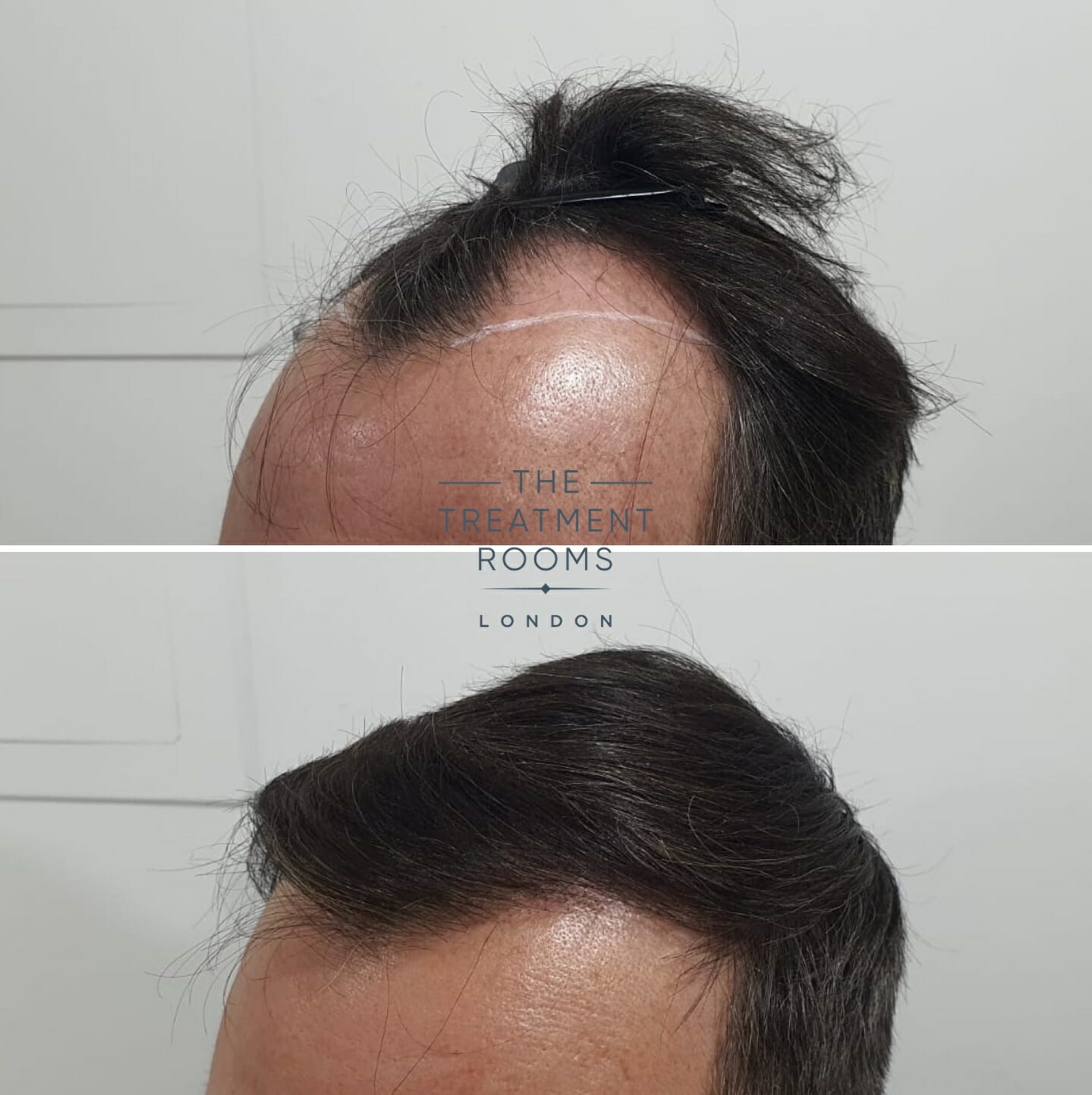 Temple hair transplant before and after 1800 grafts