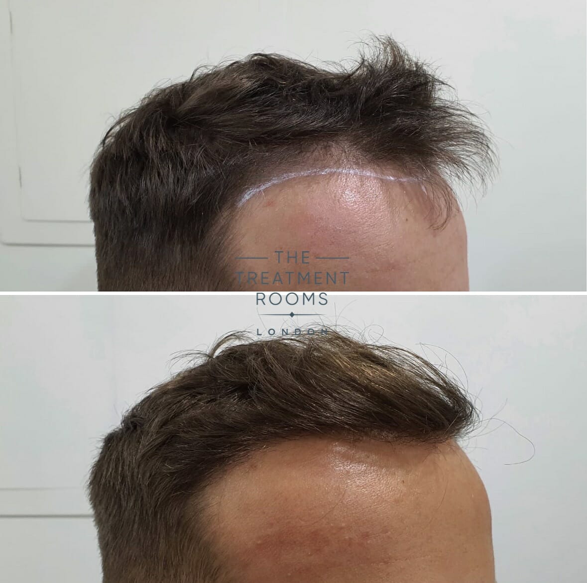 Hairline and temple hair transplant before and after