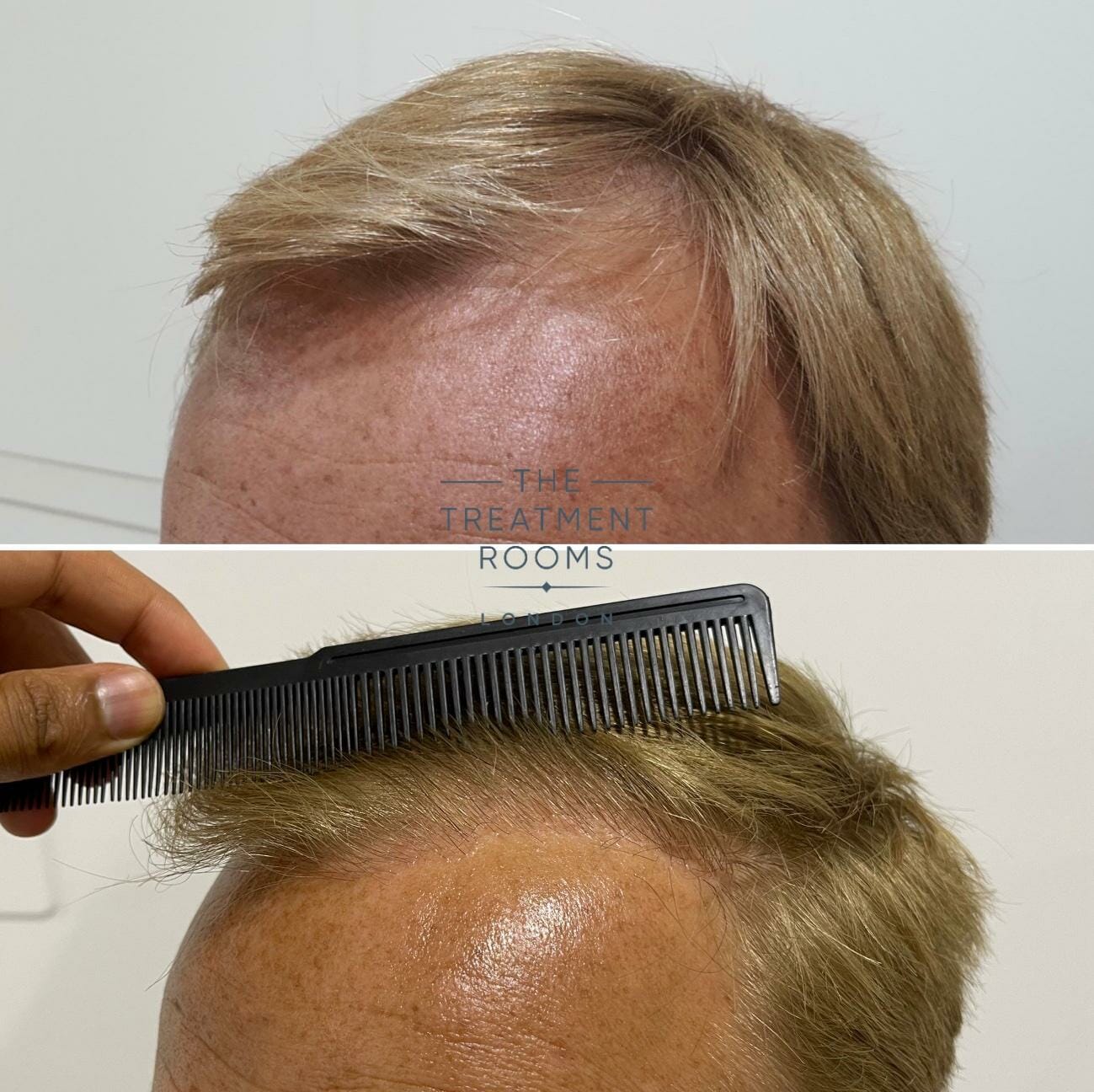 norwood 3 hair transplant