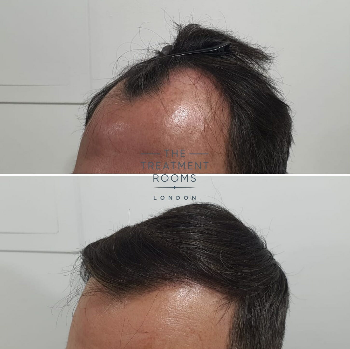 Temple hair transplant result 1800 grafts