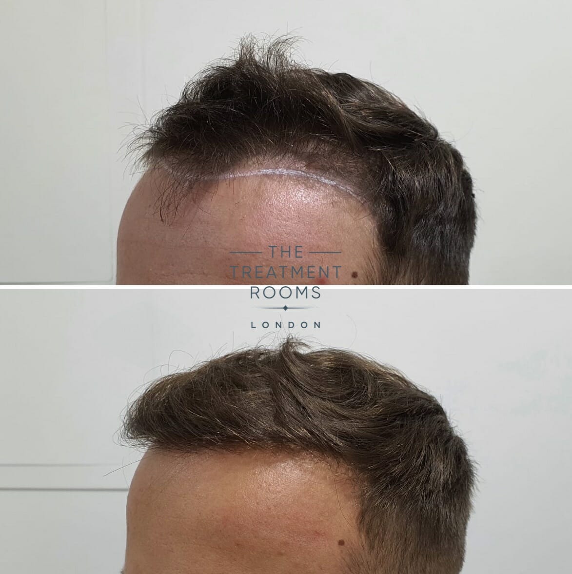 Temple hair transplant result