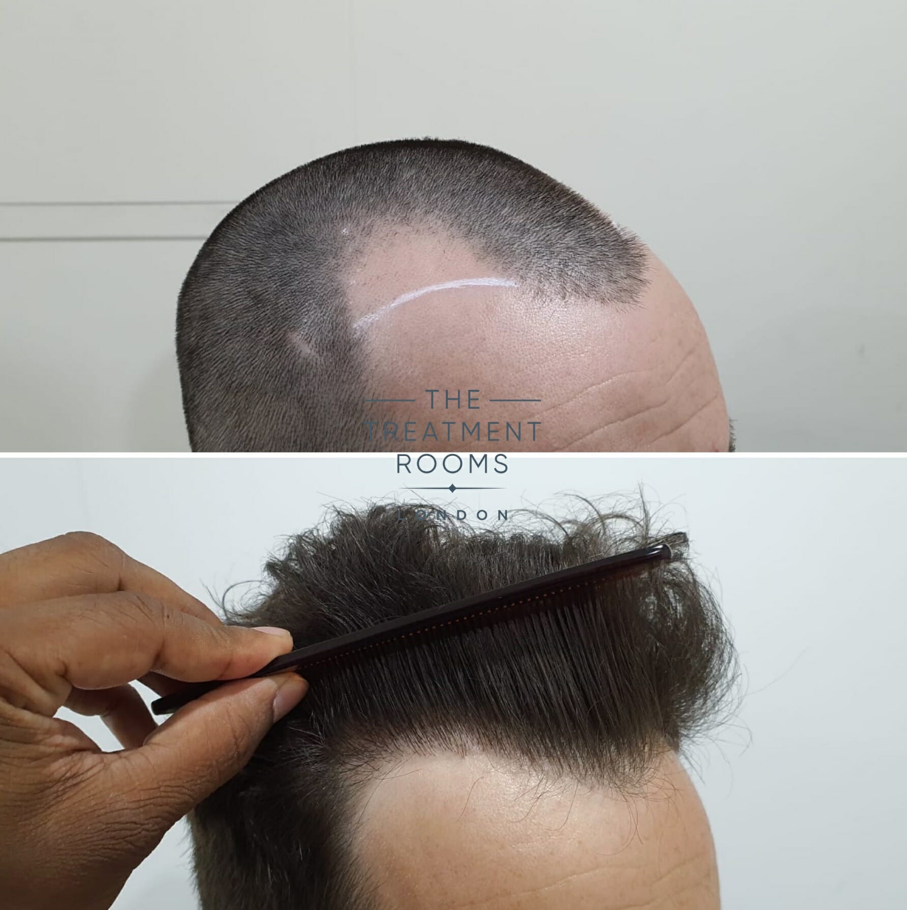 Temple hair transplant surgery 1202 grafts result