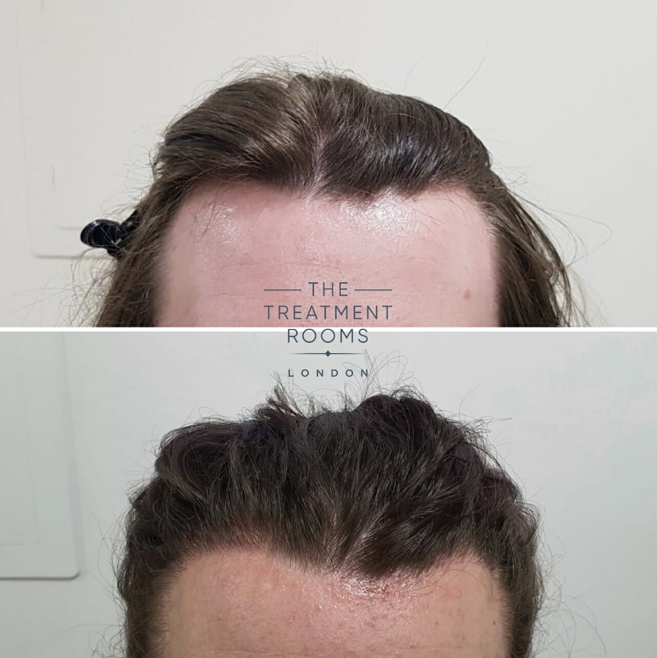 Transgender hair transplant before and after