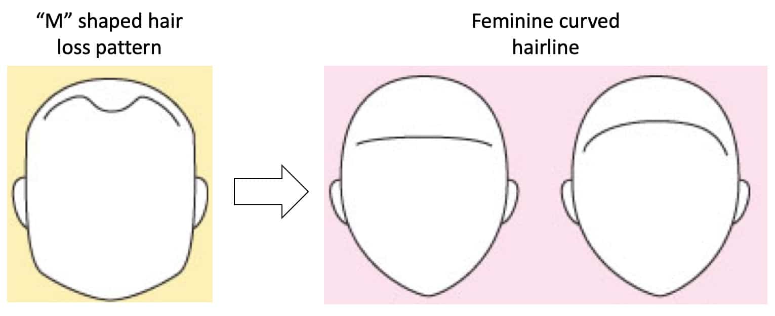 Transgender male to female hairline