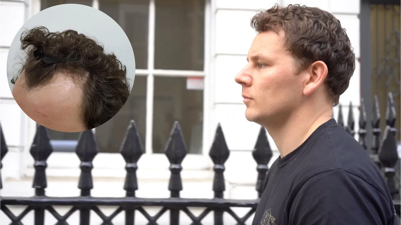 Tyler's Temple hair transplant review