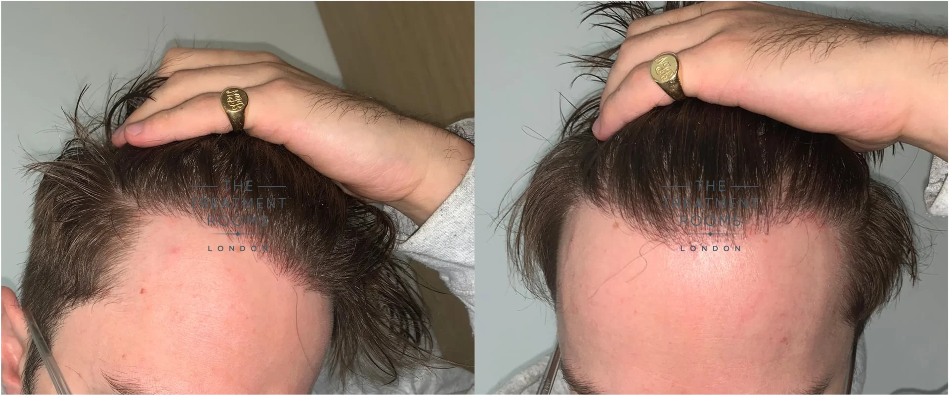 Unshaven hair transplant 1 year after surgery