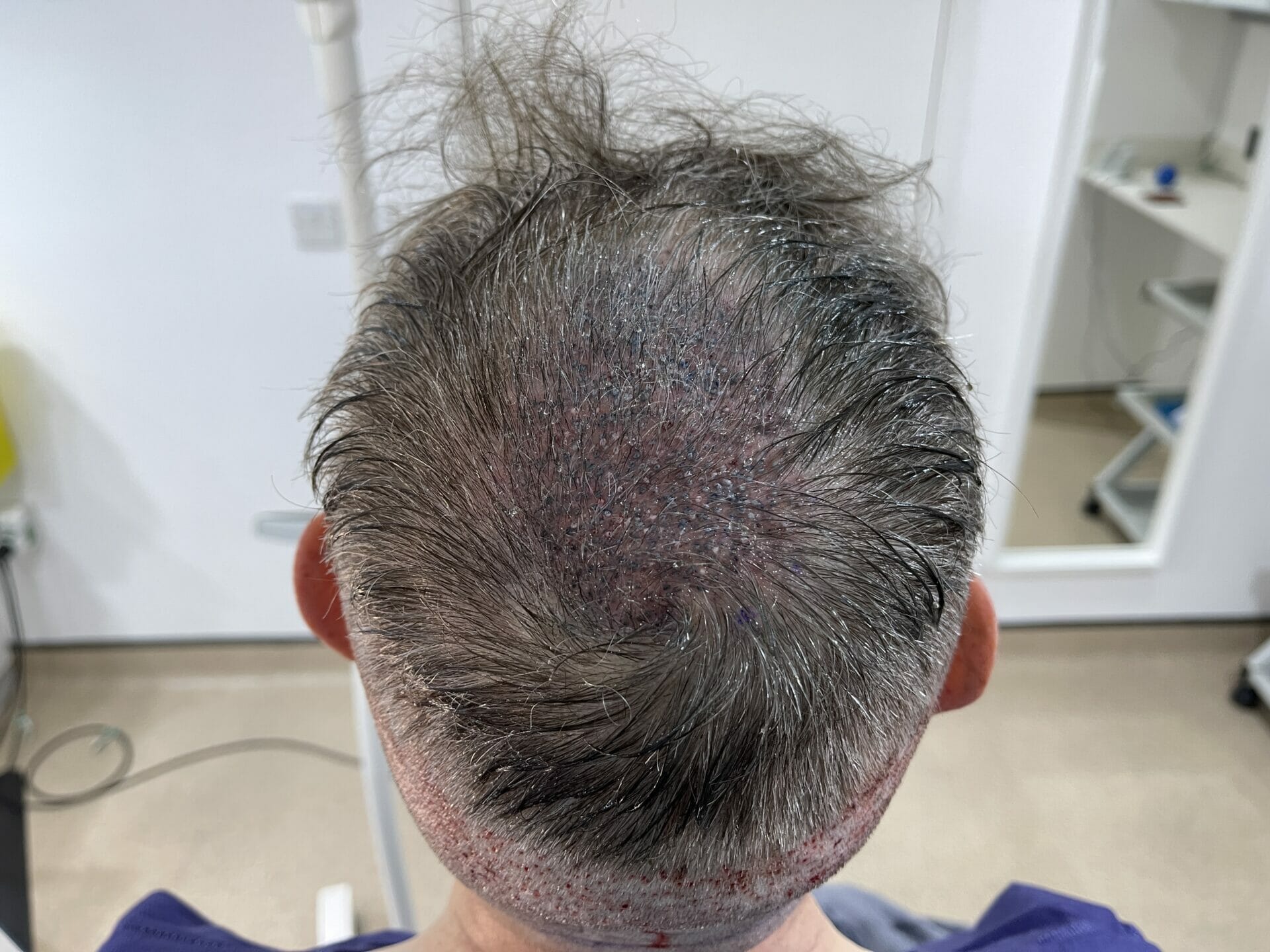 unshaven hair transplant crown