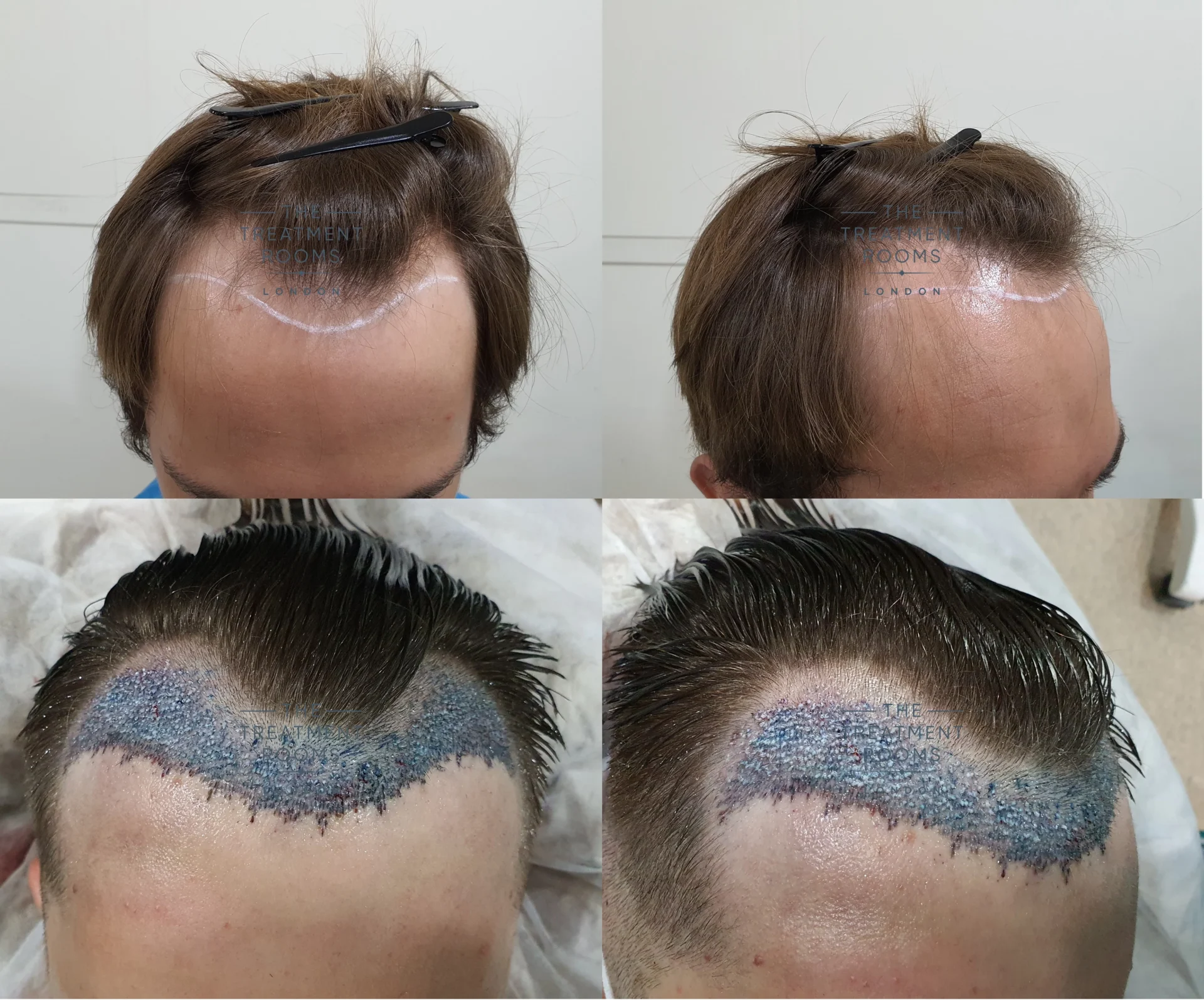Unshaven hair transplant day 1