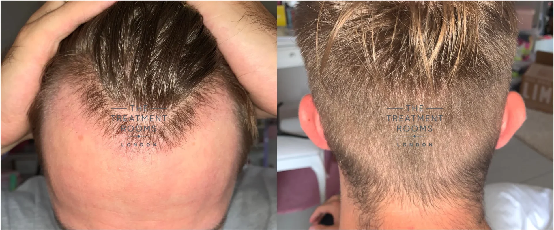 Unshaven hair transplant month 1 after surgery