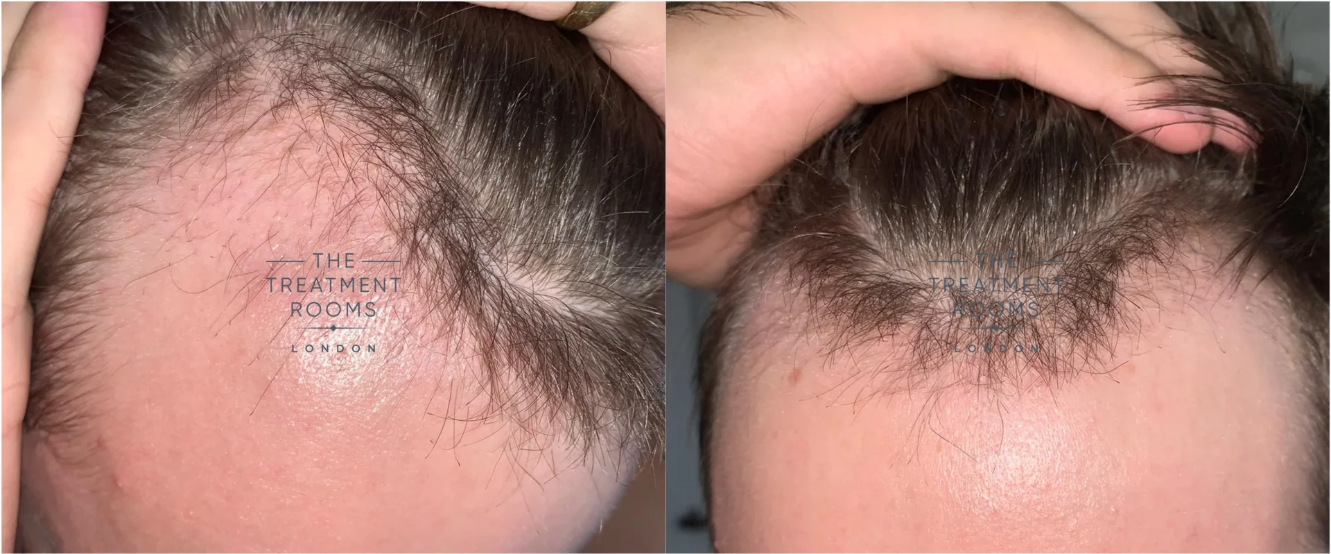 Unshaven hair transplant month 2 after surgery
