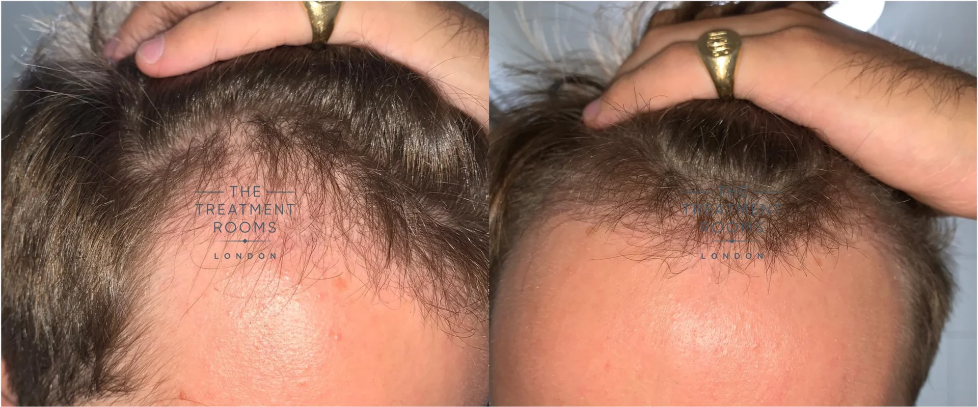 Unshaven hair transplant month 3 after surgery