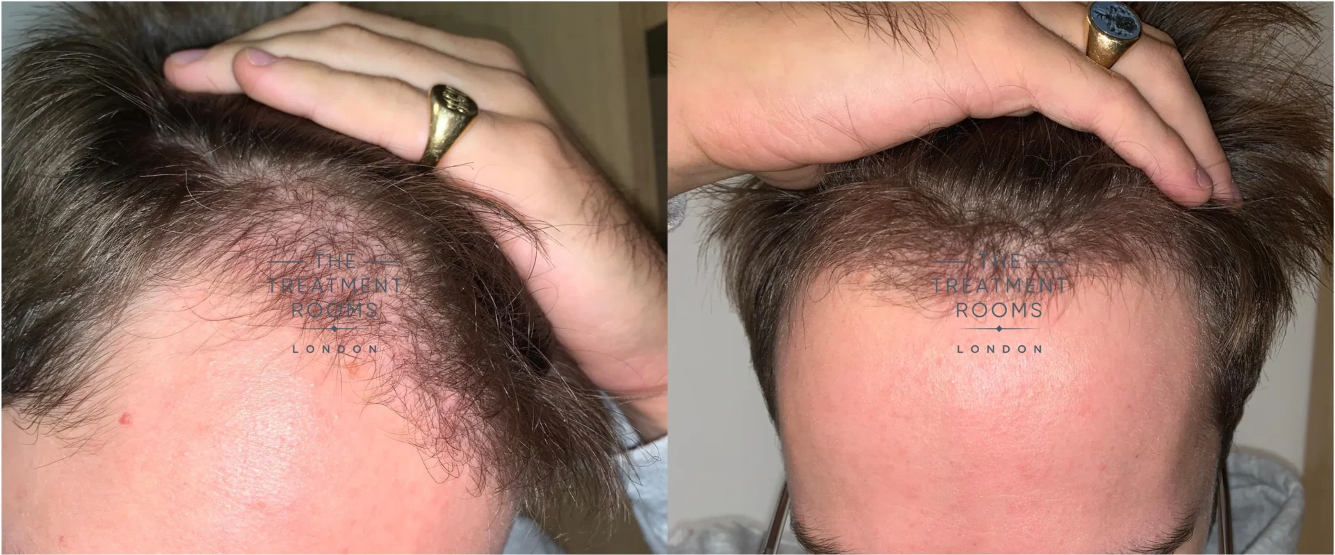 Unshaven hair transplant month 4 after surgery
